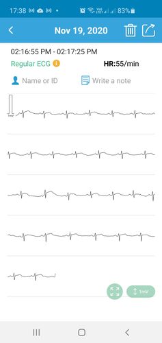 ECG